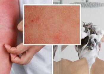 Ekzema dhe larja me ujë të nxehtë, çfarë duhet të dini nëse vuani nga ekzema 