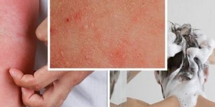 Ekzema dhe larja me ujë të nxehtë, çfarë duhet të dini nëse vuani nga ekzema