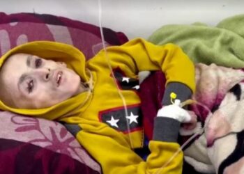 Pamjet traumatike nga Gaza/ Mbi 15 fëmijë vdesin nga uria, të tjerë përfundojnë nëpër spitale si skelete
