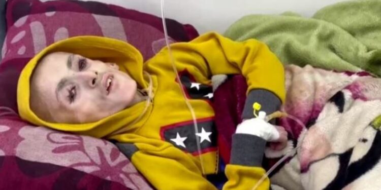 Pamjet traumatike nga Gaza/ Mbi 15 fëmijë vdesin nga uria, të tjerë përfundojnë nëpër spitale si skelete