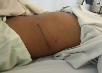 Birmani, të varfrit shesin veshkat e tyre online