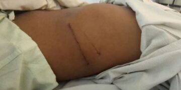 Birmani, të varfrit shesin veshkat e tyre online