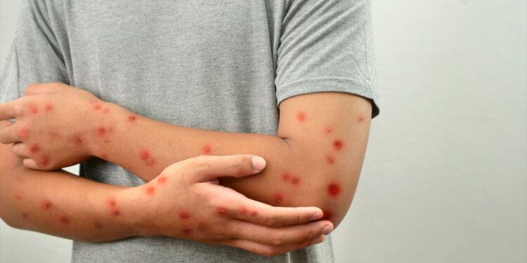 Rasti i parë me linë e majmunëve në Suedi, kompania farmaceutike Nordic: Gati të prodhojmë 10 milionë doza vaksine